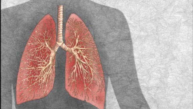 Lung cancer